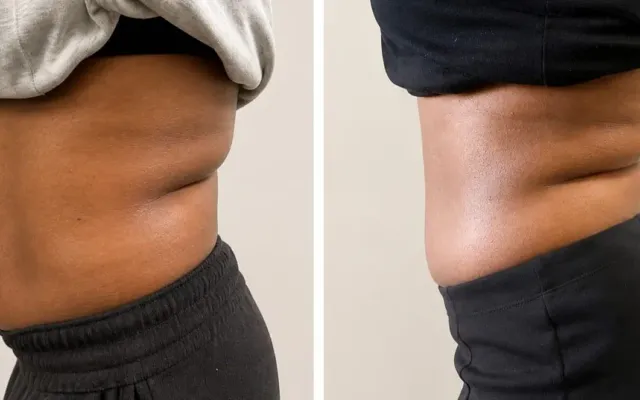 Non-surgical body sculpting treatment contouring a client's midsection