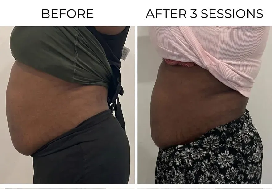 Mobile non-surgical sculpting treatment at a client's home in Basildon, Essex
