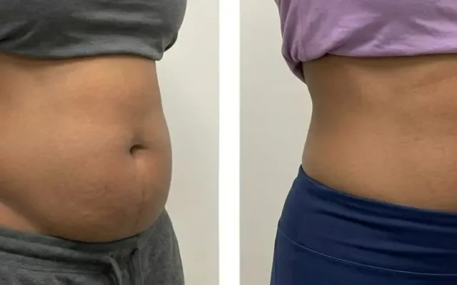 Mobile non-surgical sculpting treatment in Tonbridge & Malling, Kent
