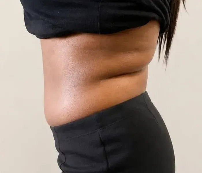 Drag to compare before and after non-surgical body sculpting at Wumi Body & Face Studio