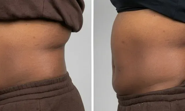 Snatched Face treatment sculpting a client's jawline and lower face