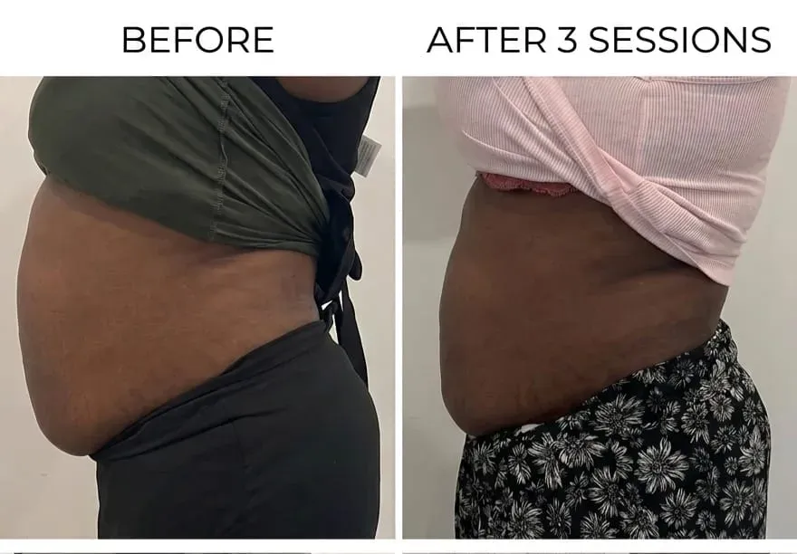 Before and after non-surgical fat reduction on the tummy after three sessions at Wumi Body & Face Studio