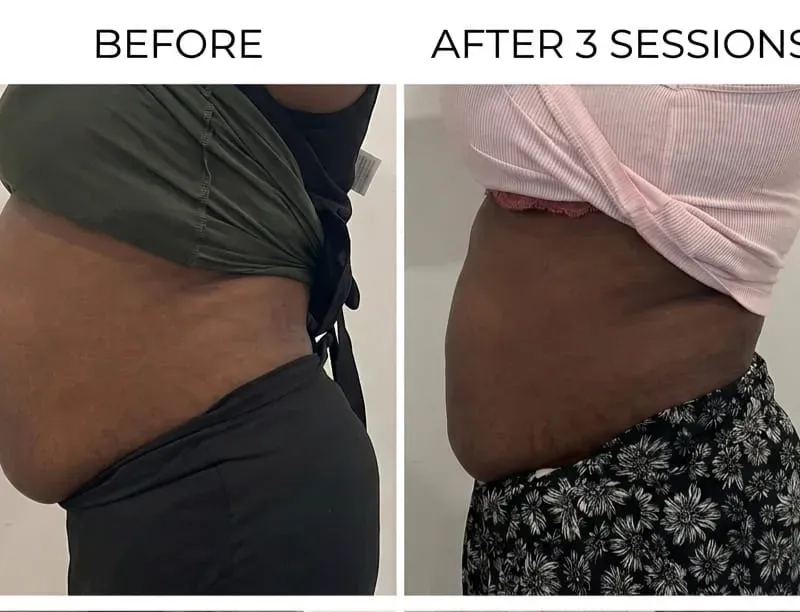 Before and after non-surgical body sculpting at Wumi Body & Face Studio — visible tummy results after 3 sessions