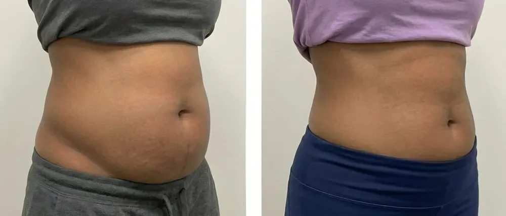 Before and after non-surgical tummy and waist sculpting at Wumi Body & Face Studio